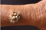 Wart On My Arm - Doctor answers on HealthTap